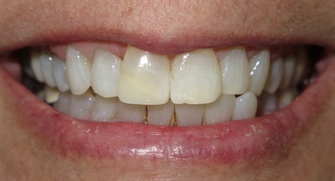 whitening 1 after